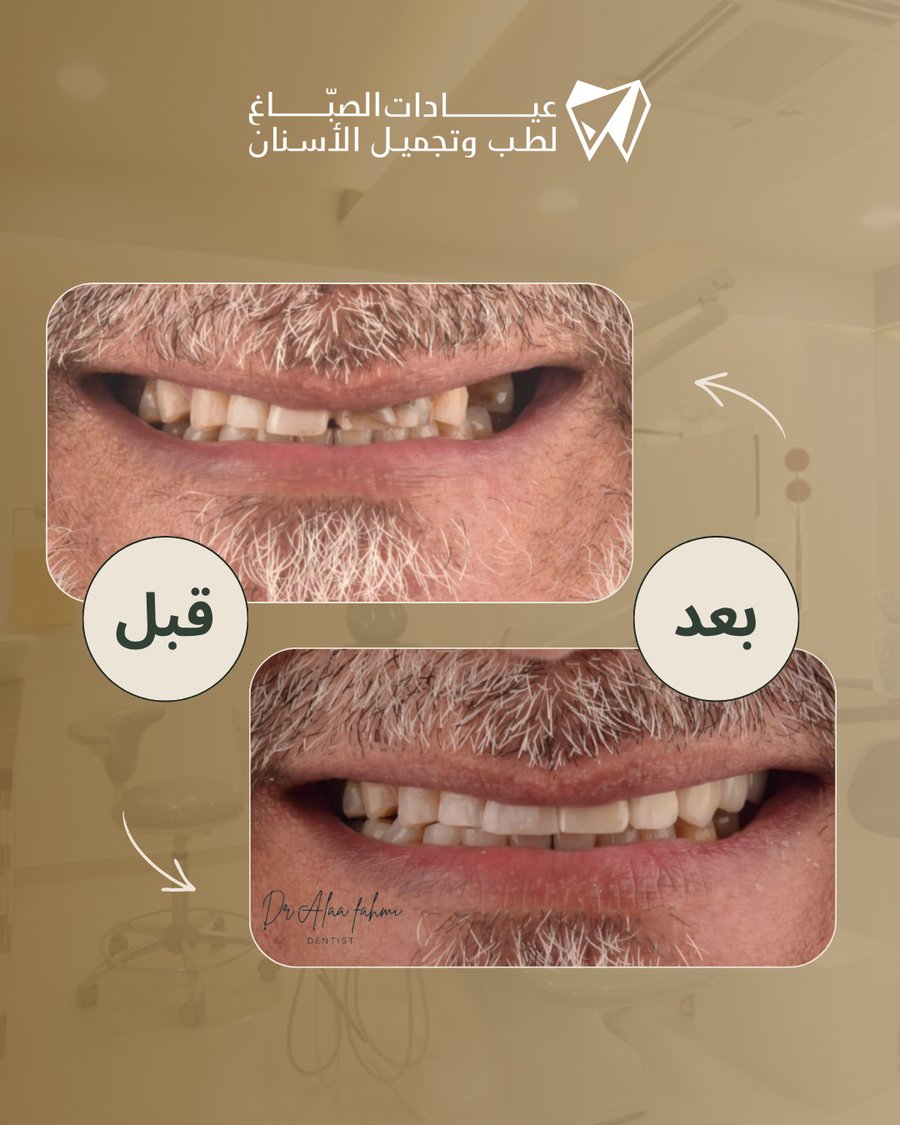 تجميل وتصميم الابتسامة